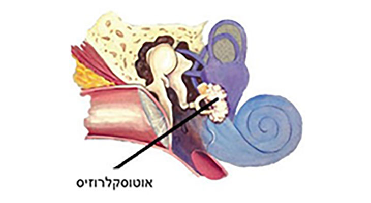 ניתוח לאוטוסקלרוזיס (סטפדוטומיה) 